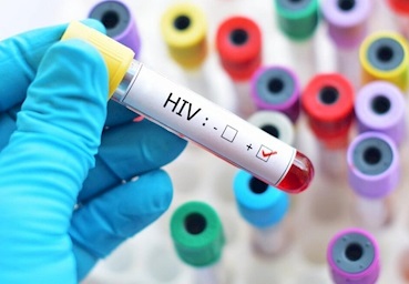 احتمال درمان بیماران HIV با سلول های بنیادی تا ۱۰ سال آینده
