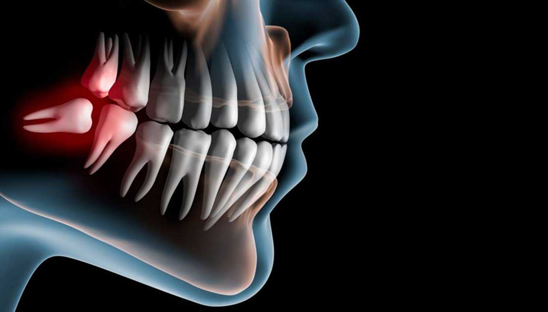 دندان عقل را بکشیم یا نه؟