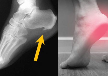 علت ایجاد «خار پاشنه» چیست و چگونه درمان می‌شود؟