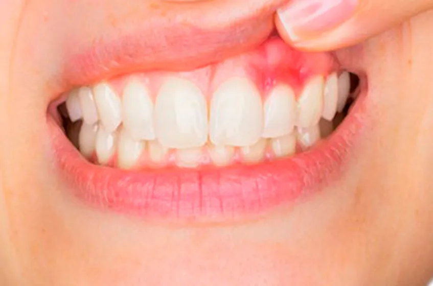 عفونت دندان و لثه چه بیماری‌هایی به دنبال دارد؟