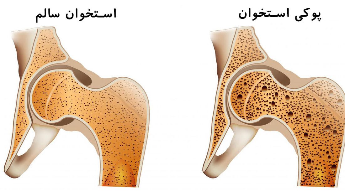 ۲۴.۵ درصد زنان تبریزی دچار پوکی استخوان هستند