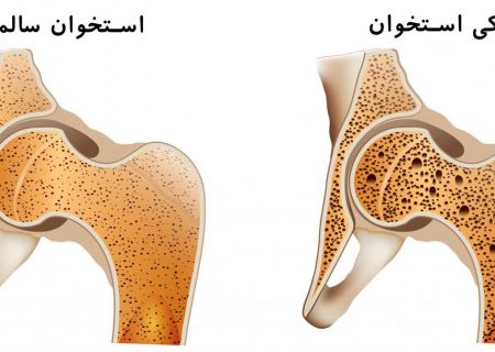 ۲۴.۵ درصد زنان تبریزی دچار پوکی استخوان هستند