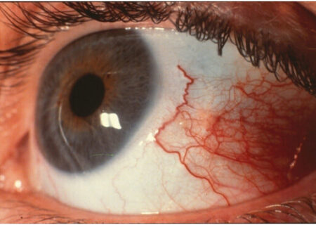 چگونه در هوای آلوده از چشم‌ها محافظت کنیم؟